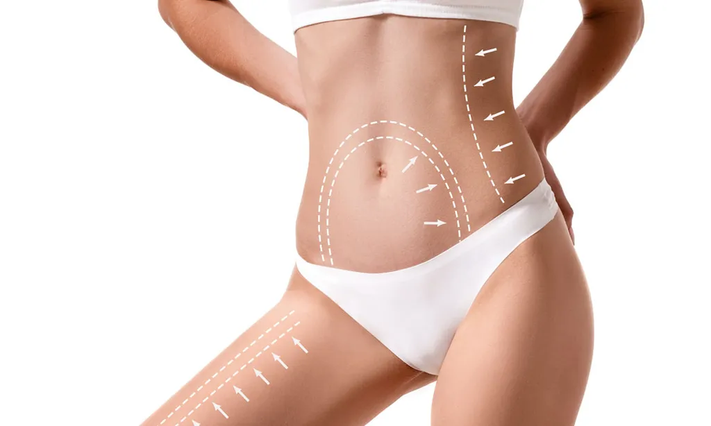 Liposuction